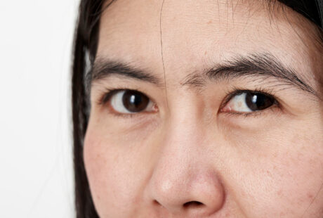 脂肪を取りすぎると、目の下の窪みが目立ちやすくなり、老けた印象を与えることがあります。