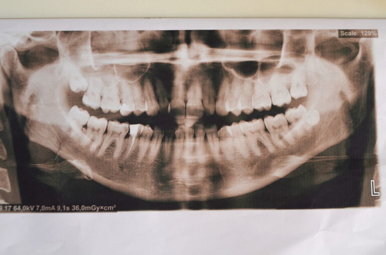 過剰歯（Hyperdontia）とは？原因・症状から治療法、費用まで専門家が徹底解説
