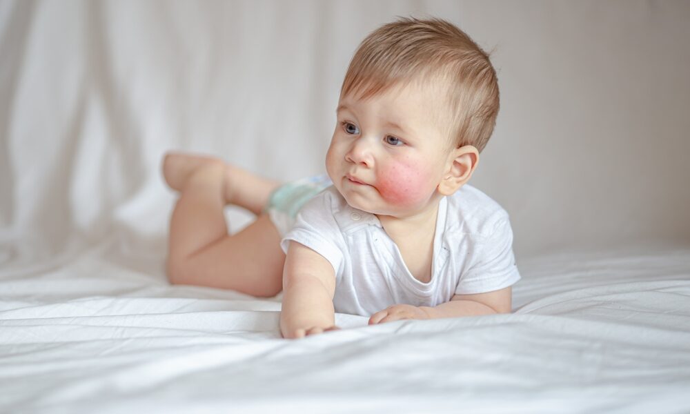 子供のアトピー性皮膚炎に効く薬 | 早く治すためのベストな選択