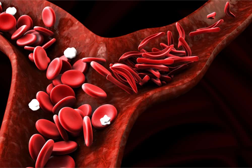 鎌状赤血球症のリスク | 知っておくべき10の重大な合併症
