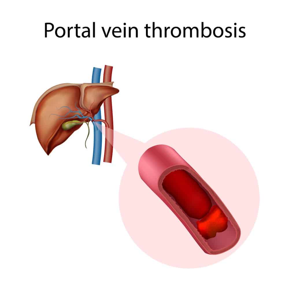 門脈血栓症の早期発見 | 合併症を未然に防ぐ方法