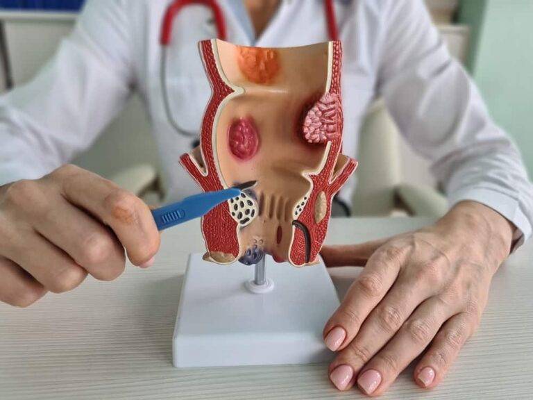 痔の真相：原因、症状、そして現代の治療法に関する完全ガイド