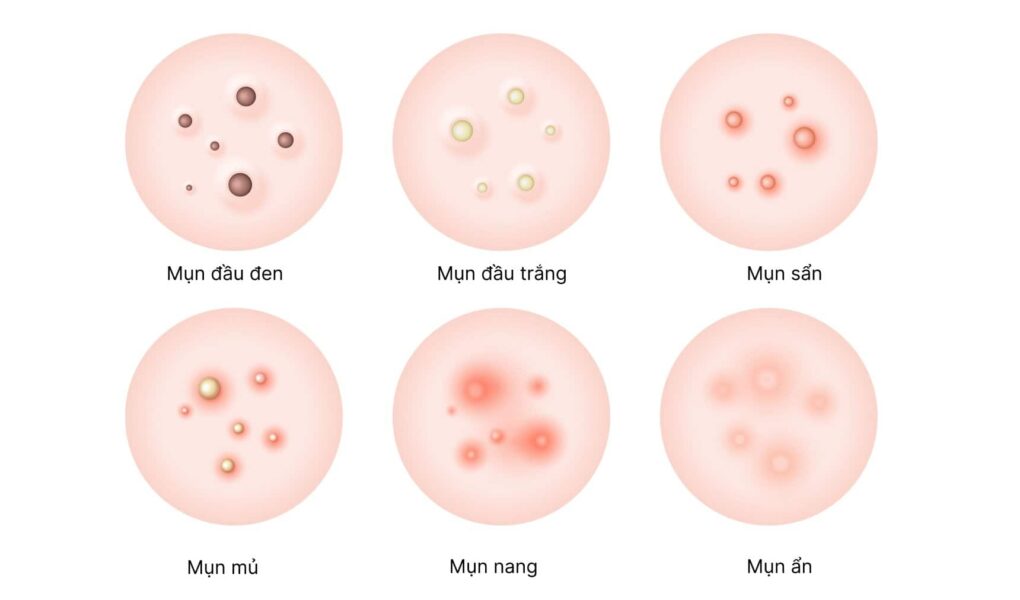 様々なニキビの見分け方: 種類別の特徴と原因・効果的な治療法