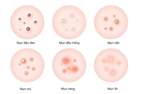 様々なニキビの見分け方: 種類別の特徴と原因・効果的な治療法