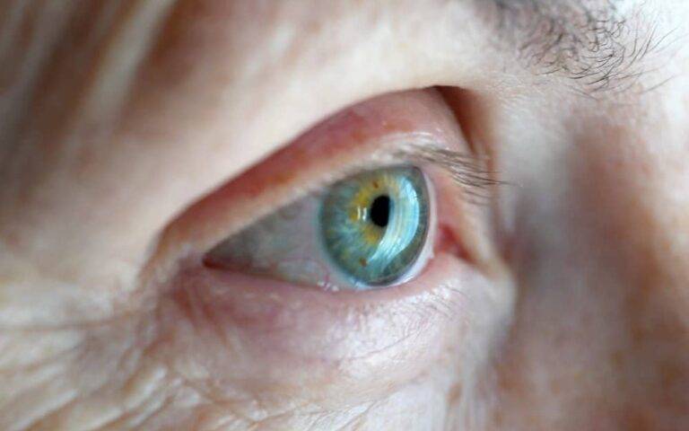 眼瞼下垂のすべて:原因、危険な自己治療、最新の治療法(手術・新薬)と費用を徹底解説 13 眼瞼下垂のすべて:原因、危険な自己治療、最新の治療法(手術・新薬)と費用を徹底解説