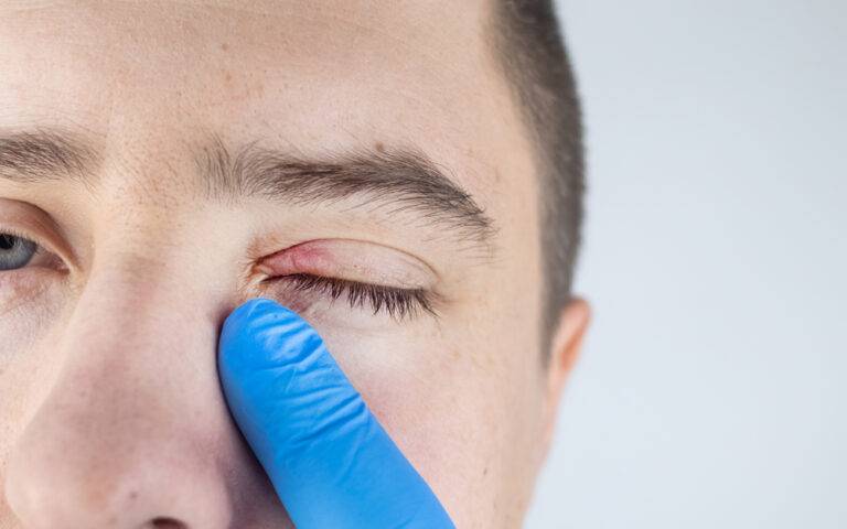 ものもらい・めばちこ完全ガイド：症状別の正しい治し方、市販薬から抗生物質の要否まで