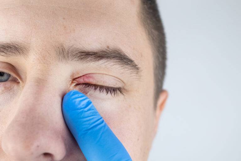ものもらい・めばちこ完全ガイド：症状別の正しい治し方、市販薬から抗生物質の要否まで