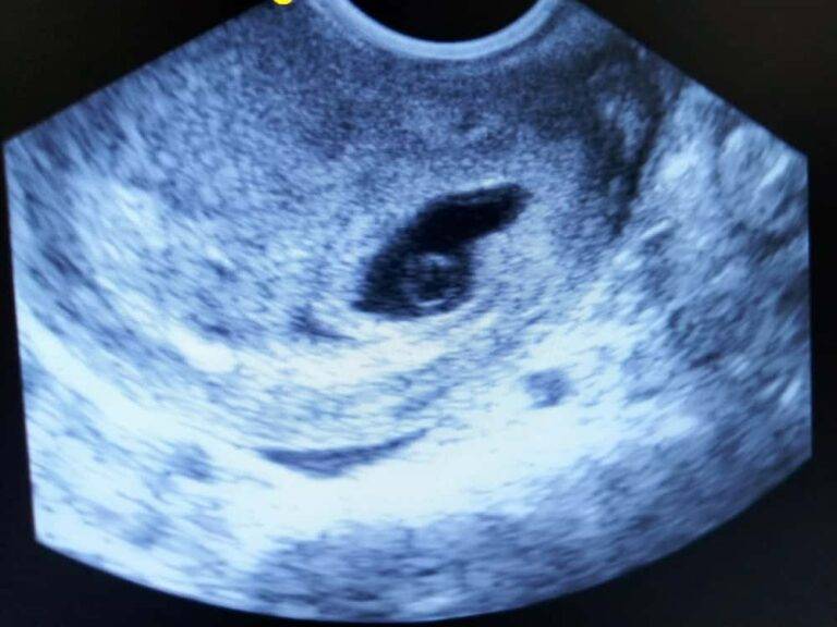 【産婦人科医が解説】胎嚢6mmは妊娠何週？心拍確認までの流れと不安解消の全知識