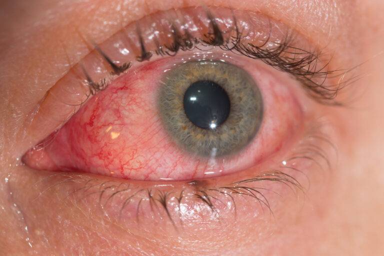 ウイルス性結膜炎（はやり目）のすべて：症状・潜伏期間から治療、感染対策まで医師が徹底解説
