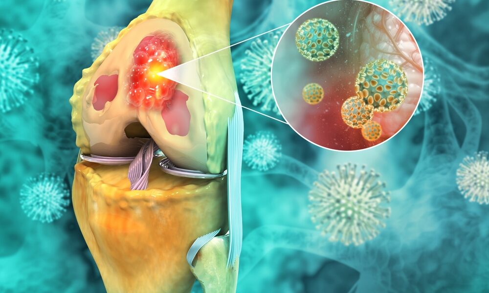 骨肉腫の原因とは？知っておくべき重要なポイント