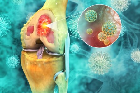 骨肉腫の原因とは？知っておくべき重要なポイント