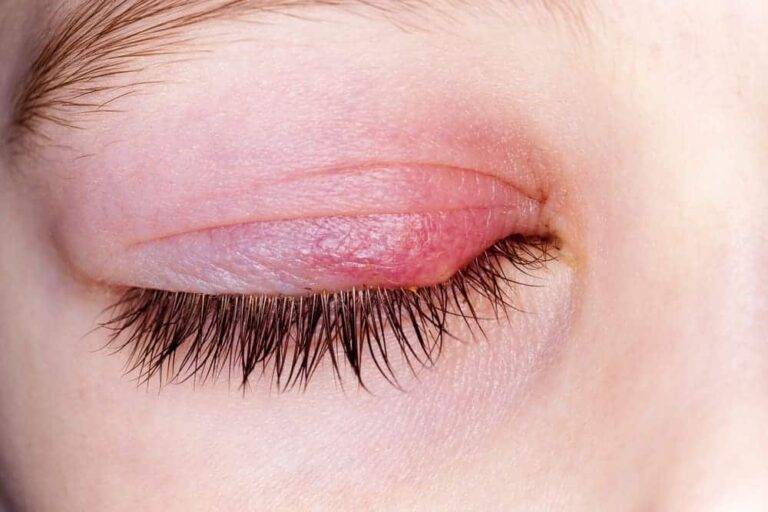 ものもらいの治し方｜痛い麦粒腫・しこりの霰粒腫の違いと最速回復ガイド