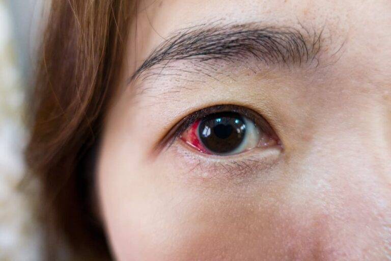 網膜剥離：失明を防ぐために知っておくべき症状・原因・最新治療のすべて