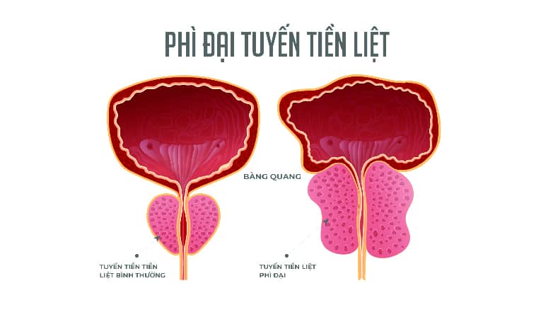 前立腺肥大は危険か？| そのリスクと対処法を探る