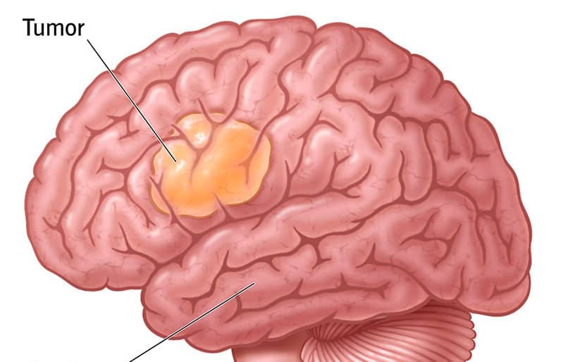 良性腫瘍 | 安全で心配いらない「U」について知ろう