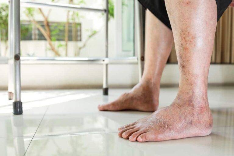 糖尿病による皮膚症状のすべて：見過ごしてはいけない9つのサインと専門的ケア