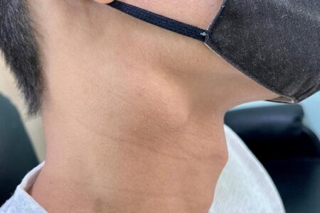 リンパ節結核は再発するのか？| 症状と予防法を詳解