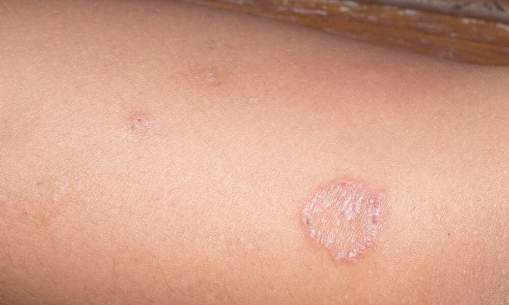 かゆみのない皮膚真菌症：症状、原因、そして日本での最新治療法