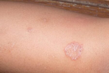 かゆみのない皮膚真菌症：症状、原因、そして日本での最新治療法