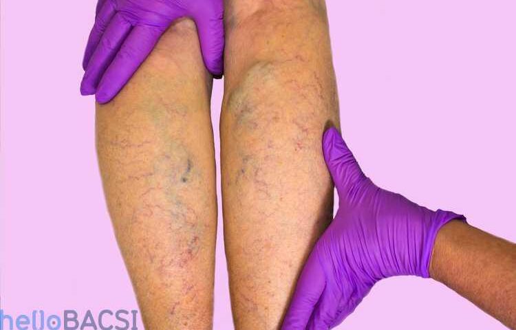 【科学的根拠に基づく】静脈炎のすべて：深部静脈血栓症（DVT）と表在性血栓性静脈炎の症状・原因・最新治療法を徹底解説