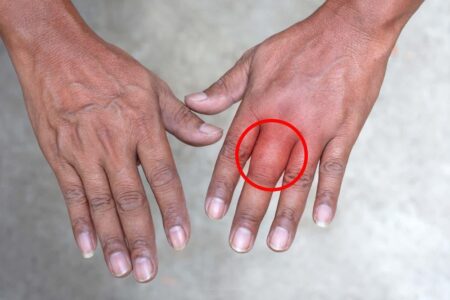 指の腫れの原因とは？効果的な治療法を徹底解説