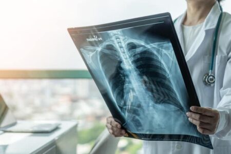 胸水貯留のX線撮影で病気を診断できるか？詳細な分析とは