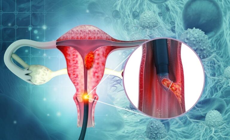 【医師監修】子宮頸がんの真の原因「HPV」とは？日本の現状と最新の予防法を徹底解説