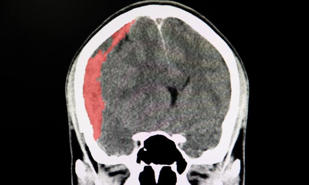 硬膜下血腫とは？その原因と症状を徹底解説