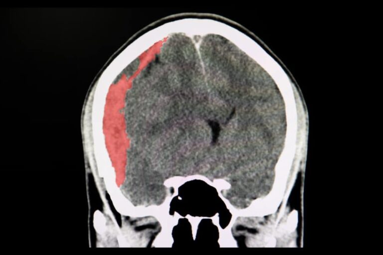 硬膜下血腫とは？原因・症状から治療、再発予防のすべて