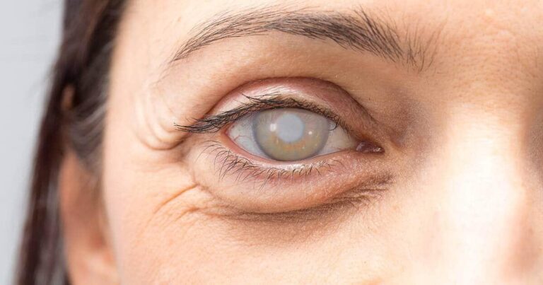 フェイコ手術（白内障超音波乳化吸引術）のすべて：最新眼内レンズの比較から費用、高額療養費制度まで徹底解説