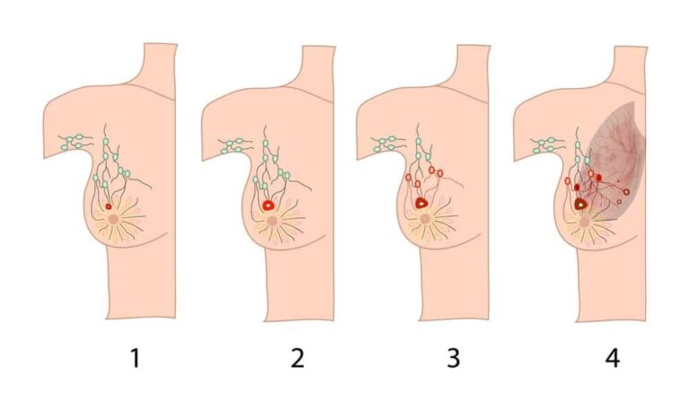 日本の初期乳がん治療のすべて：ASCO最新指針、遺伝性乳がん、経済的支援まで徹底解説