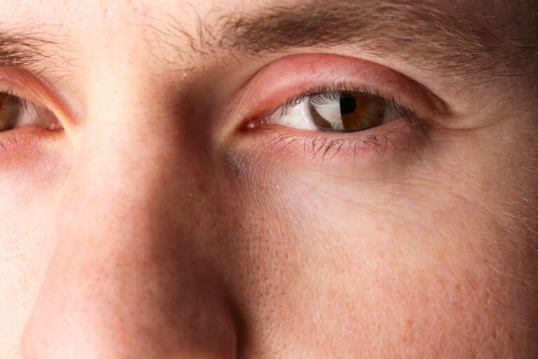 上まぶたの腫れ：原因、治療法、そして知っておくべき危険なサインの完全ガイド
