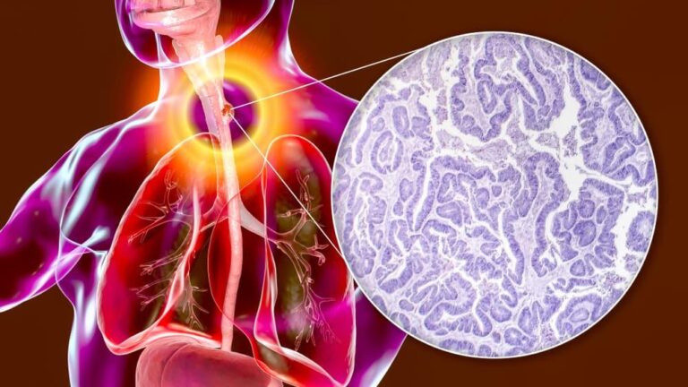 早期食道がんの完全ガイド：日本の最新治療法、生存率、生活の質を徹底解説