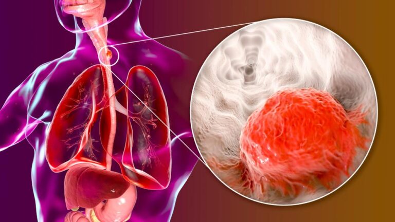 食道がんステージ3：最新の治療法と生存率、予後を専門家が徹底解説