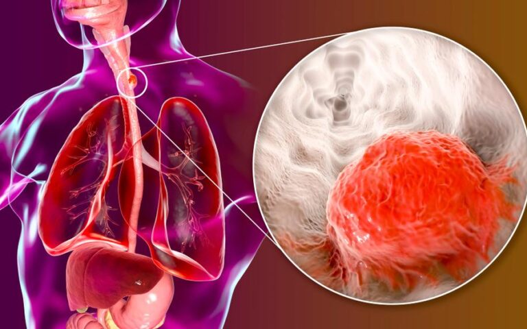 食道がんステージ3：最新の治療法と生存率、予後を専門家が徹底解説
