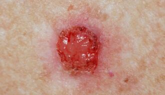 「日本の扁平上皮癌治療、世界標準との間に潜む「ギャップ」とは？」