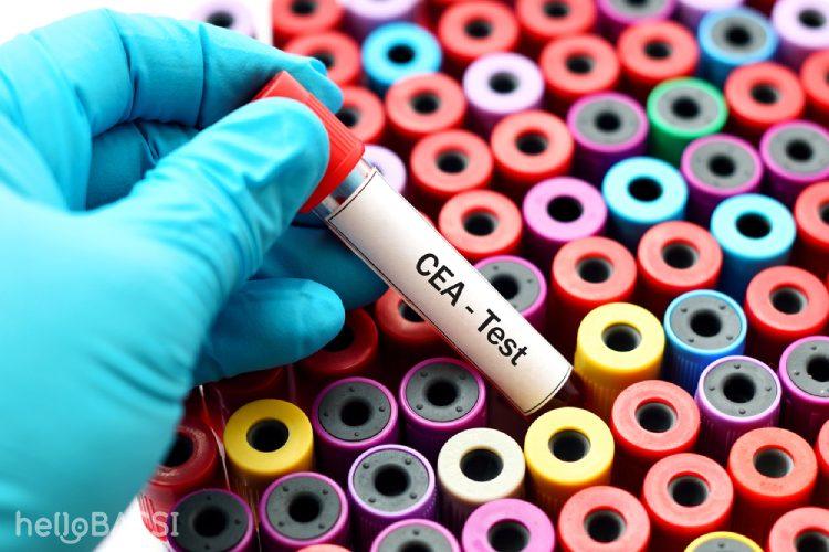 【科学的根拠に基づく】CEA検査のすべて：がんの早期発見から治療効果判定、基準値と高値の原因まで徹底解説
