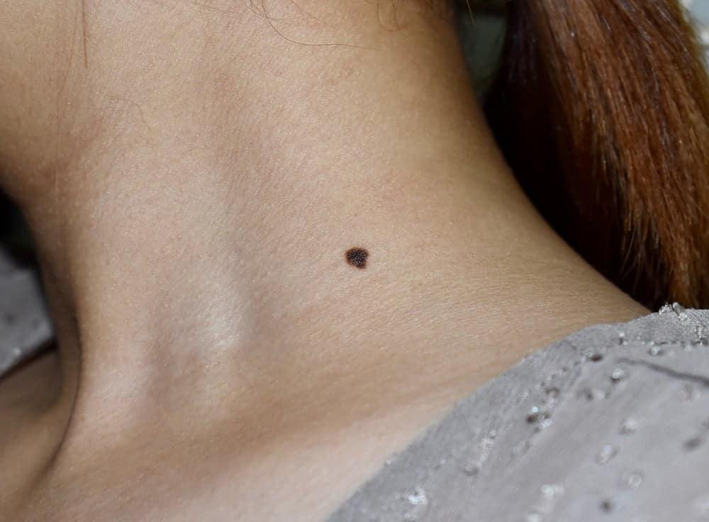 皮膚がん検査の全知識：自己チェックから確定診断、日本の最新ガイドラインまで徹底解説