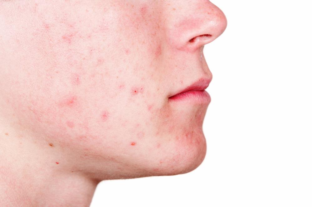 ニキビ後の「赤み」を消す方法【皮膚科専門医が徹底解説】原因からセルフケア、美容医療のすべて