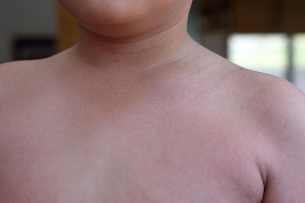 【医師監修】子どもの猩紅熱 完全ガイド：症状の見分け方、合併症リスク、最新の治療と登園基準のすべて