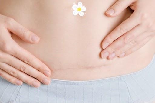 帝王切開で生まれた赤ちゃんの免疫力強化法：科学的根拠に基づく母親のための包括的ガイド