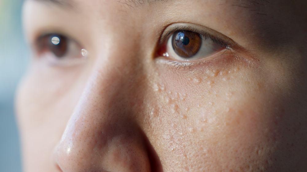 【医師監修】自宅でできるイボ治療の全て｜市販薬の効果・使い方と危険なイボの見分け方
