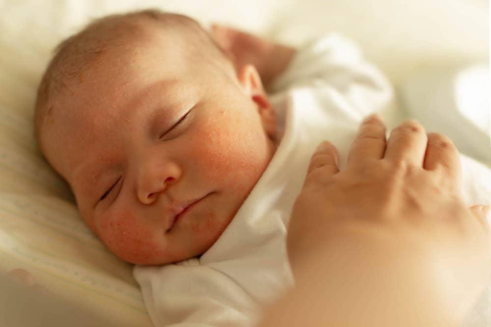 赤ちゃんの眉毛の黄色いかさぶた（乳児脂漏性湿疹）：原因、安全な治し方、専門家が教えるケアの完全ガイド