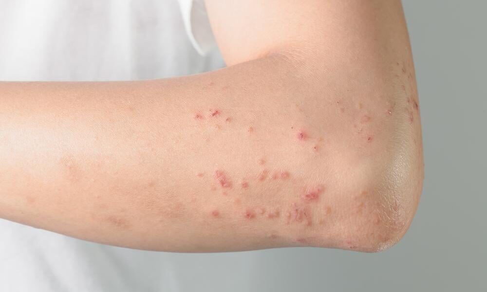 【専門家監修】皮膚の発疹：原因、疾患、治療法の包括的ガイド