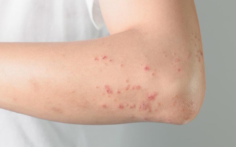 皮膚の発疹：原因、疾患、治療法の包括的ガイド