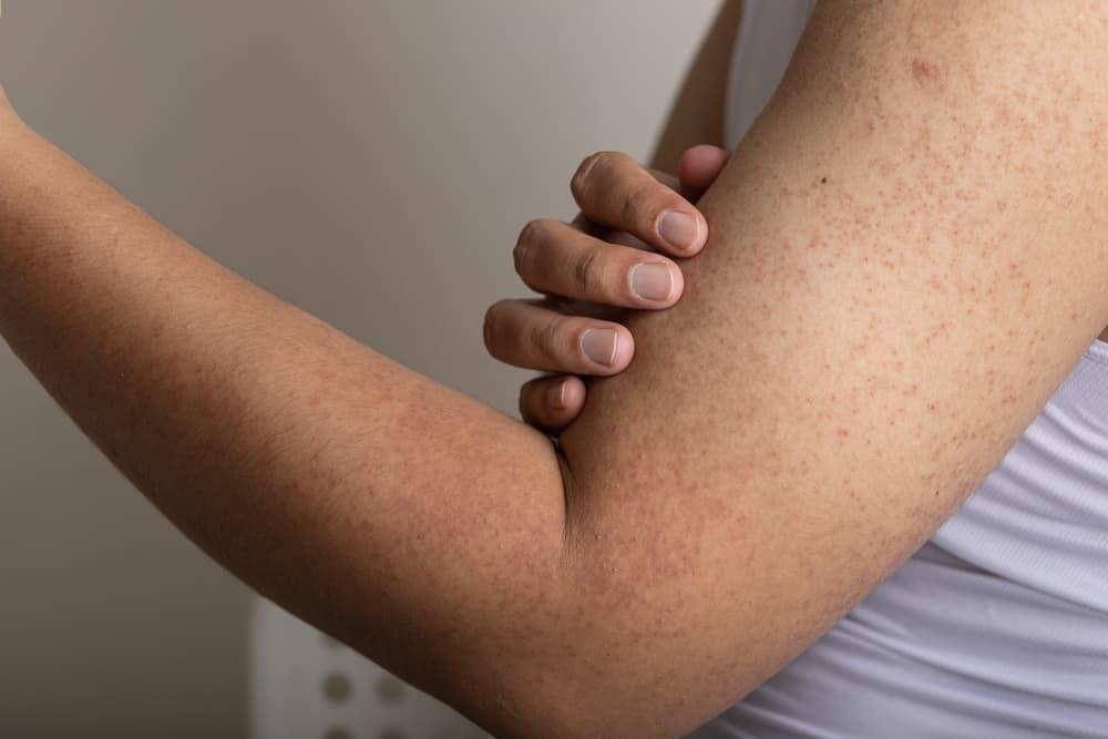 毛孔性苔癬（二の腕のブツブツ）とは？原因・症状から市販薬・皮膚科治療まで専門医が科学的根拠に基づき徹底解説