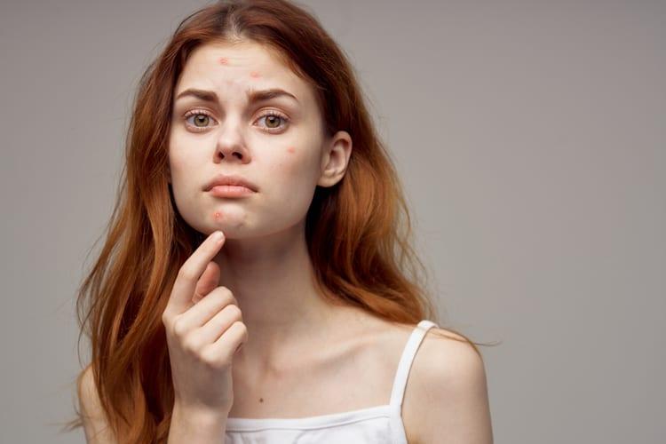 【医師監修】ピルはニキビに効く？皮膚科・婦人科医が解説する効果と副作用、日本の保険適用と費用
