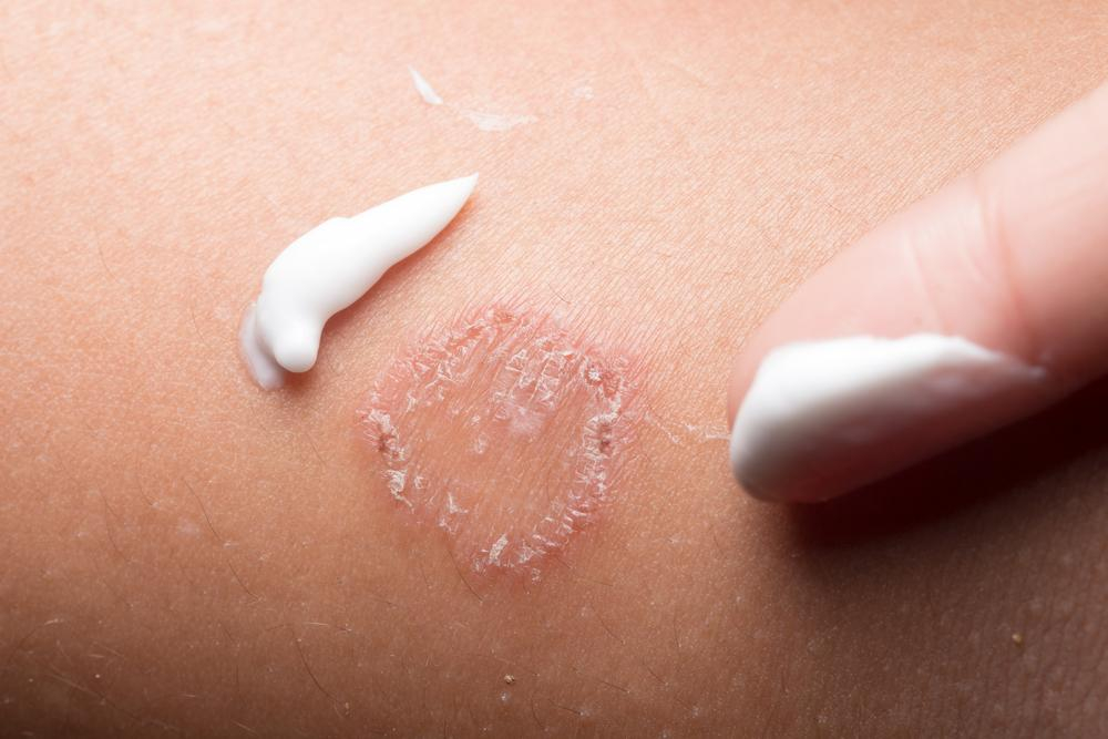 これって何？光沢苔癬と体にできる赤い輪っか状の湿疹（環状紅斑）- 皮膚科専門医が原因・見分け方・治療法を徹底解説