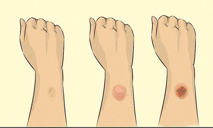【医師監修】化学薬品による皮膚損傷の完全ガイド：原因・応急処置から専門的治療、予防策のすべて