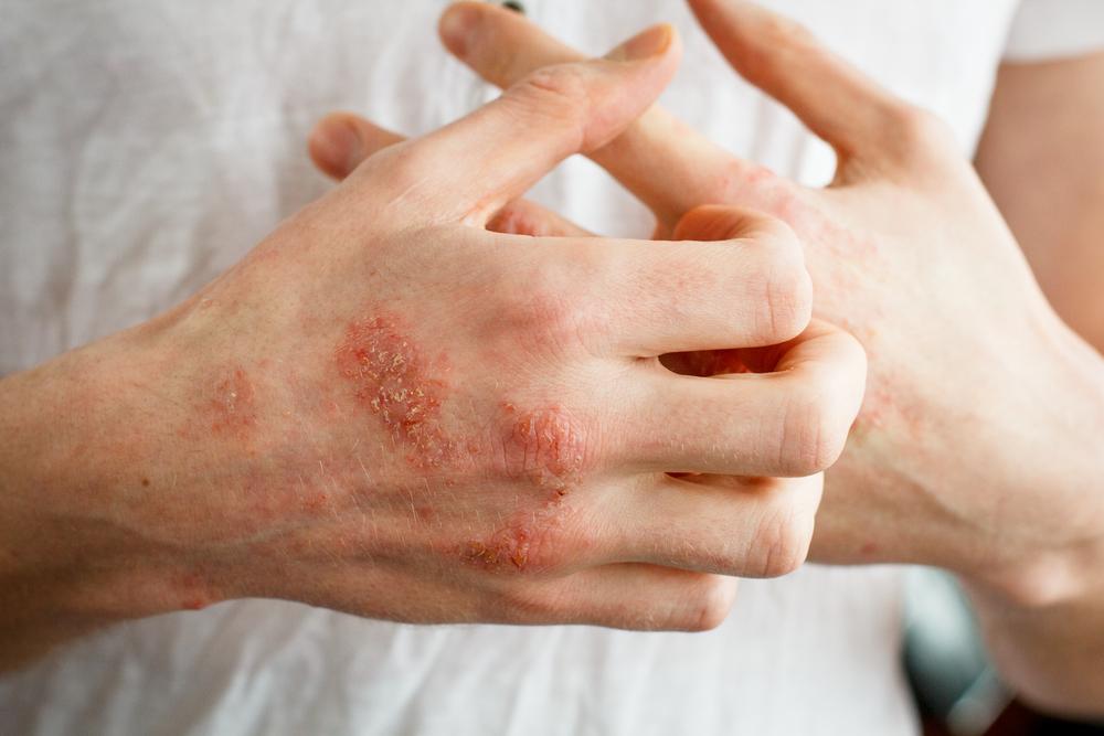 【医師監修】壊死性皮膚感染症（人食いバクテリア）のすべて：症状・原因・最新治療法を徹底解説